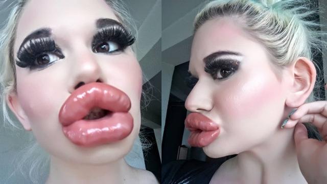 20 Kali Lakukan Operasi Bibir, Wanita Ini Mengaku Masih Tidak Puas